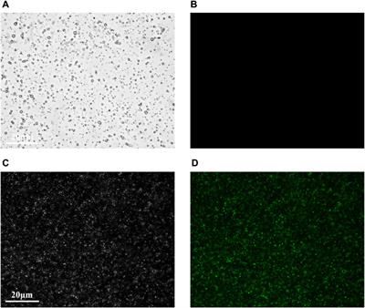 Targeted microbubbles combined with low-power focused ultrasound promote the thrombolysis of acute deep vein thrombosis